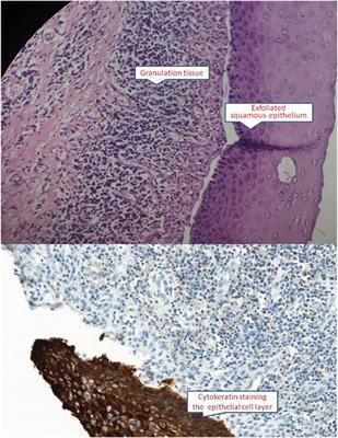 Case Report: Recessive Dystrophic Epidermolysis Bullosa With Severe Esophageal Stenosis: A Case Report and Literature Review